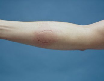 bite mark impression evidence bite mark impression evidence